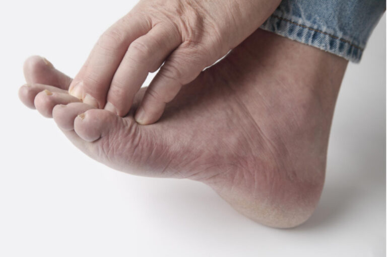 Peripheral Neuropathy: nerve damage in the foot